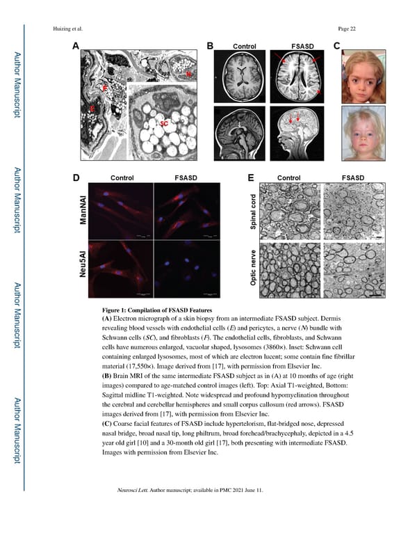 Free Sialic Acid Storage Disorder: Progress and Promise - Page 22